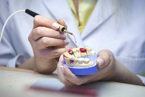 How Long Do Dental Crowns Last My Local Dentists Northmead