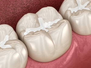 broken or chipped tooth Northmead