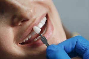 dental veneers northmead