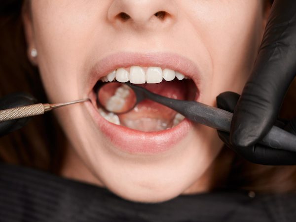 fissure sealants northmead